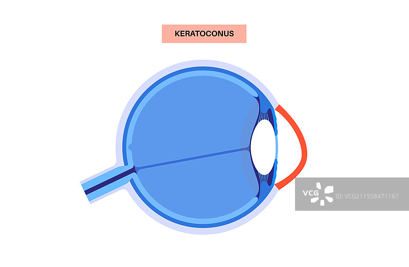 白内障眼病插图图片素材