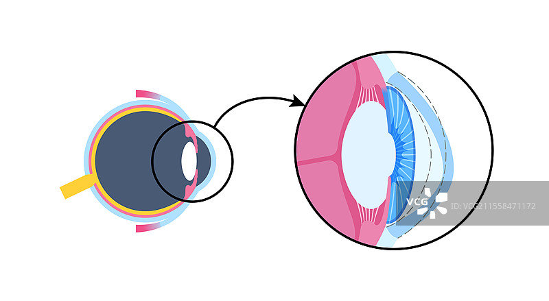 白内障眼病插图图片素材
