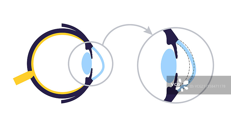 白内障眼病插图图片素材