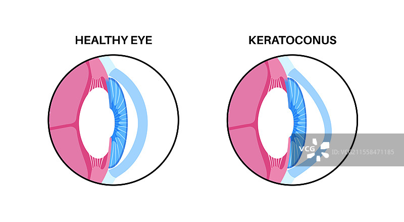 白内障眼病插图图片素材
