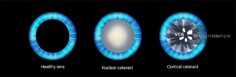 白内障眼病插图图片素材