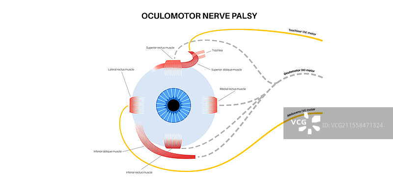 动眼神经麻痹插图图片素材