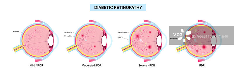 糖尿病性视网膜病变插图图片素材