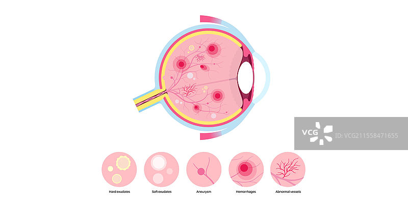糖尿病视网膜病变插图图片素材