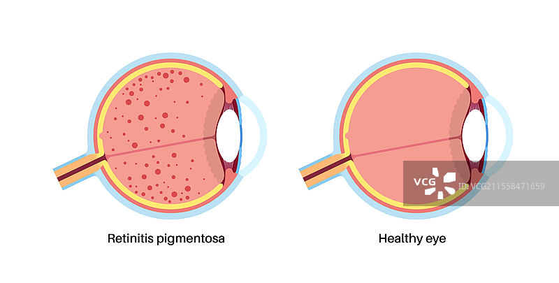 视网膜色素变性插图图片素材
