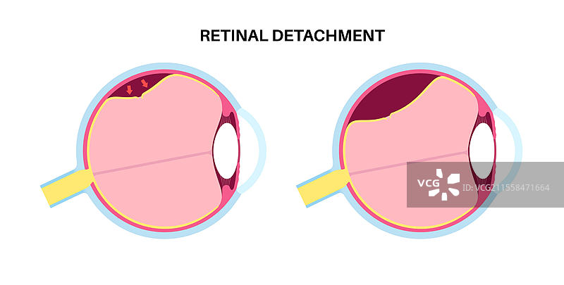 视网膜脱落插图图片素材