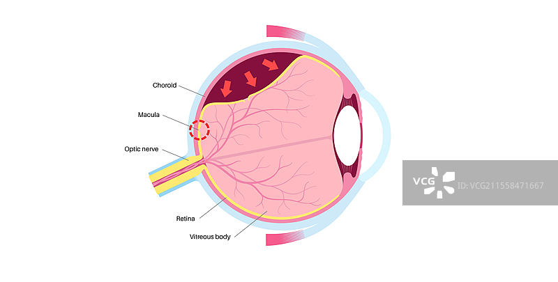视网膜脱落插图图片素材