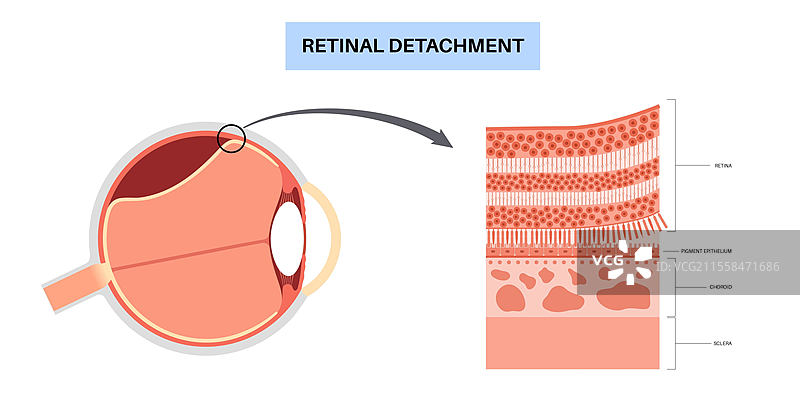 视网膜脱落插图图片素材