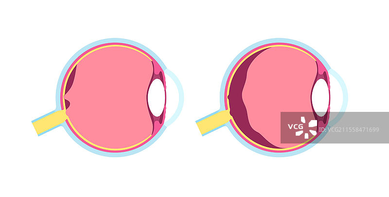 后玻璃体脱离插图图片素材