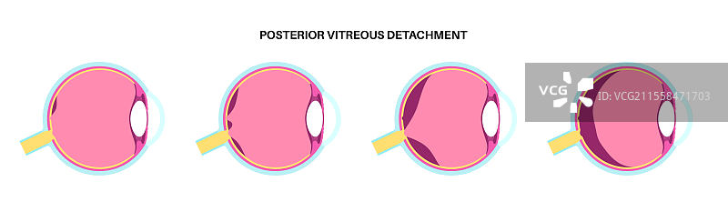 后玻璃体脱离插图图片素材