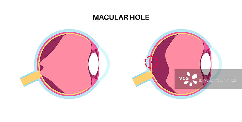 黄斑孔疾病插图图片素材