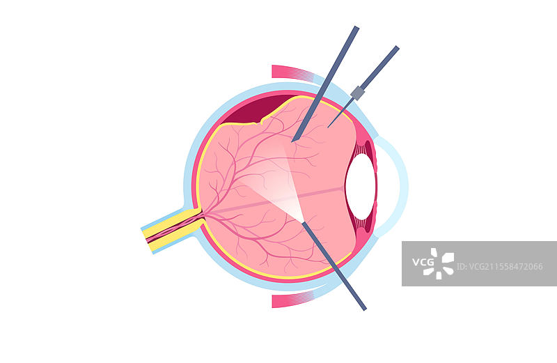 玻璃体切除手术插图图片素材