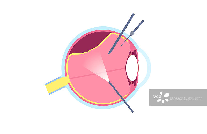 玻璃体切除手术插图图片素材