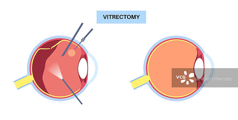 玻璃体切除手术插图图片素材