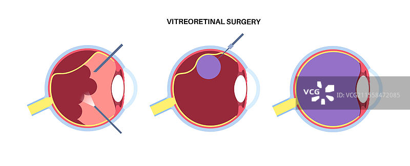 玻璃体视网膜手术插图图片素材