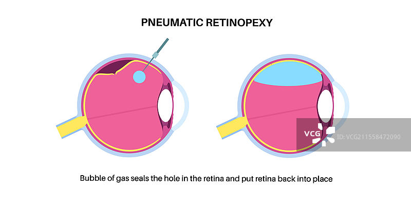 气压视网膜复位术插图图片素材
