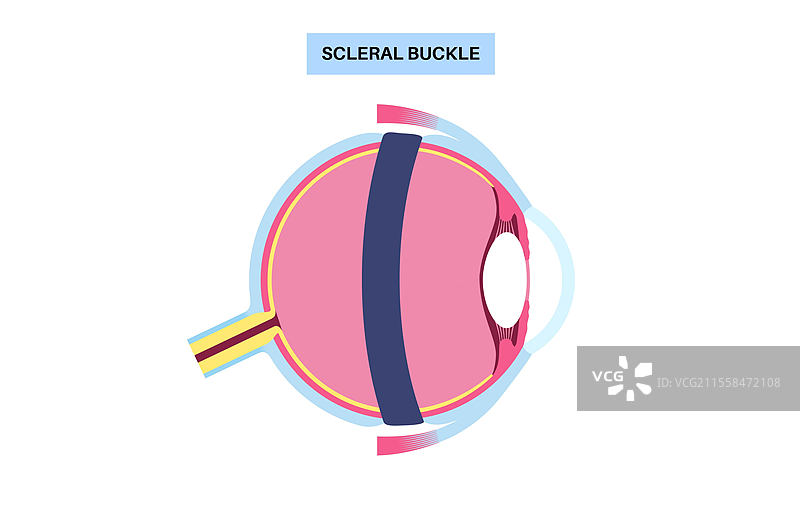 巩膜带手术示意图图片素材