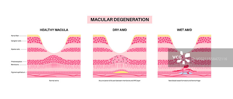 黄斑变性插图图片素材