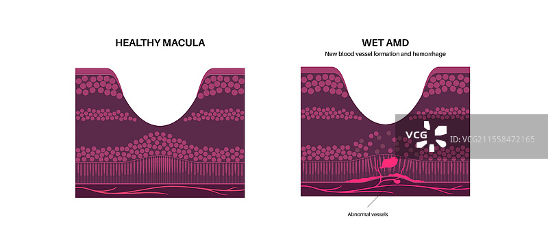 黄斑变性插图图片素材