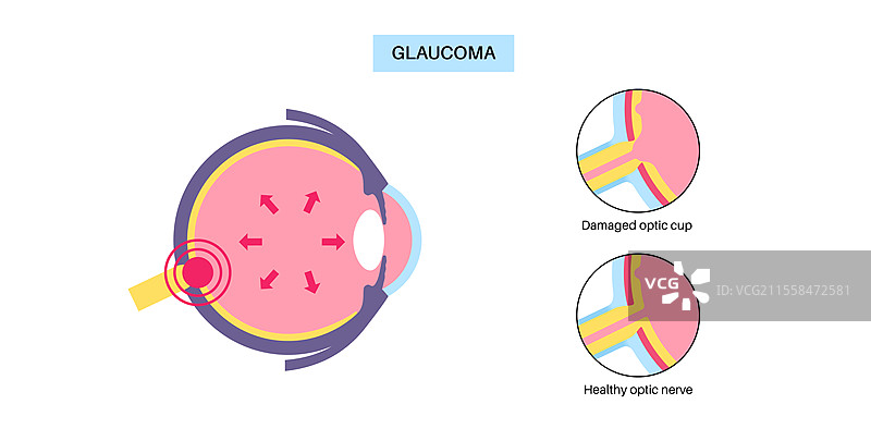 青光眼中受损的视神经杯插图图片素材