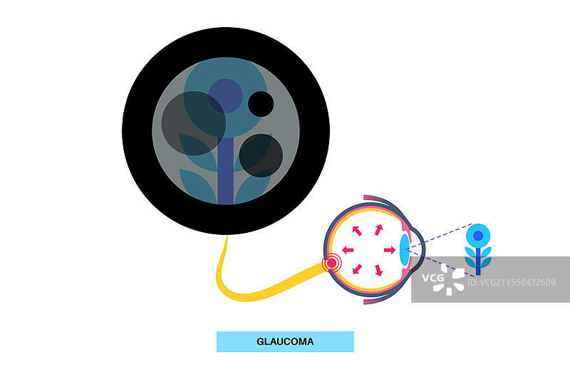 青光眼眼病插图图片素材
