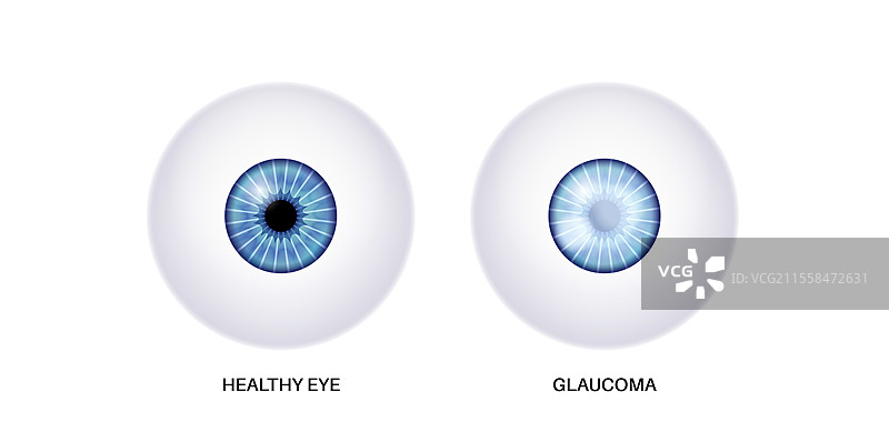 青光眼眼病插图图片素材