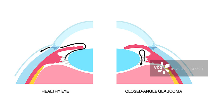 青光眼眼病插图图片素材