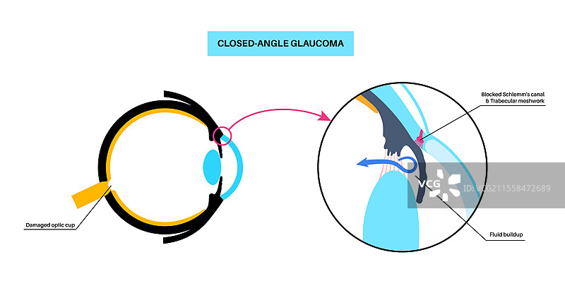 青光眼眼病插图图片素材