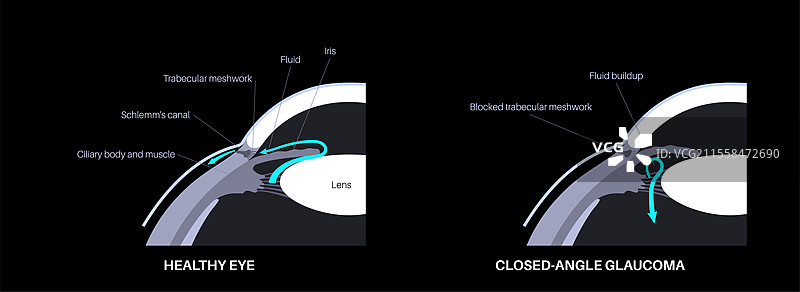 青光眼眼病插图图片素材