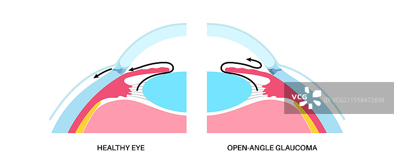 青光眼眼病插图图片素材