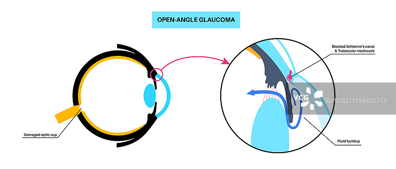 青光眼眼病插图图片素材