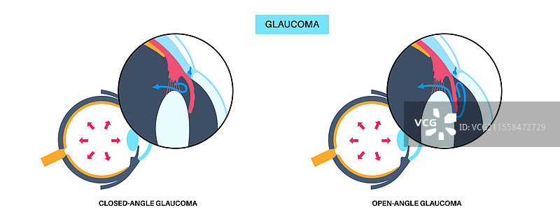 青光眼眼病插图图片素材