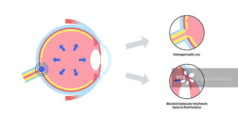 青光眼眼病插图图片素材
