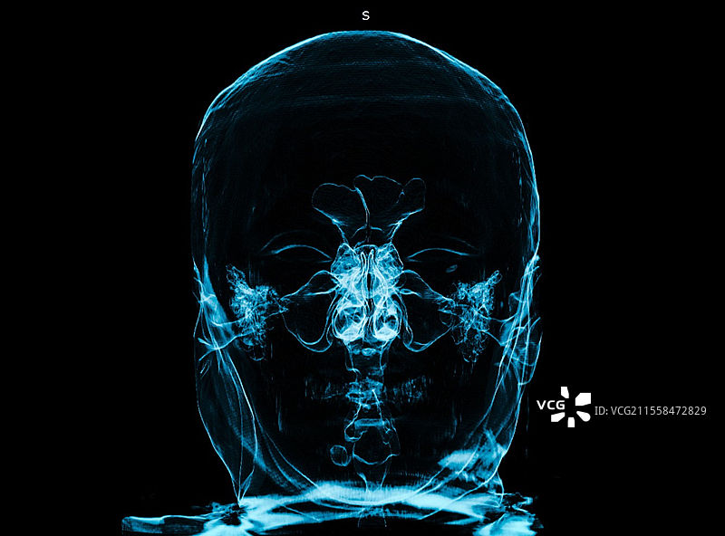 上呼吸道，3D CT扫描图片素材