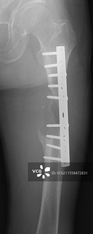 钉合骨折，X光片图片素材