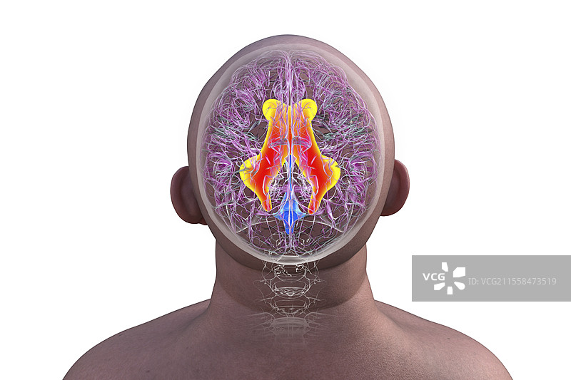 脑部侧脑室扩大，插图图片素材