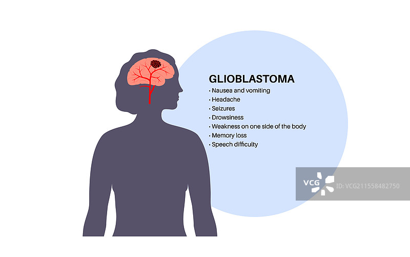 胶质母细胞瘤脑癌图片素材