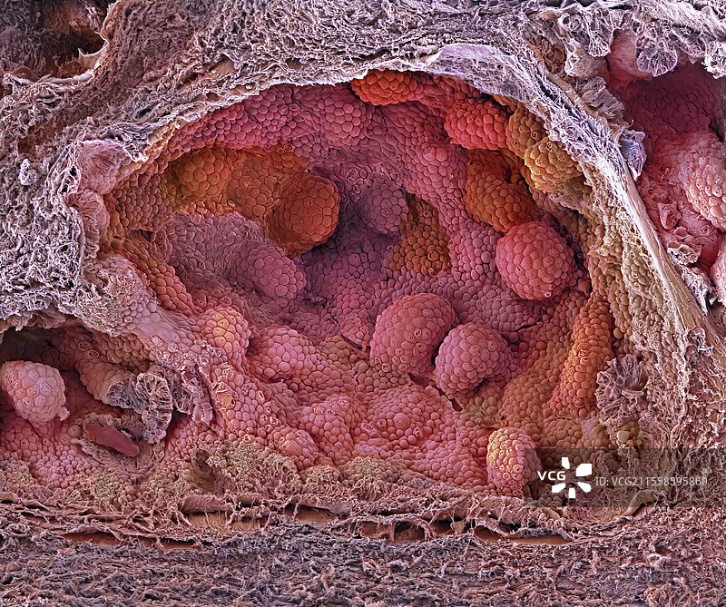 前列腺癌，扫描电子显微镜图像图片素材