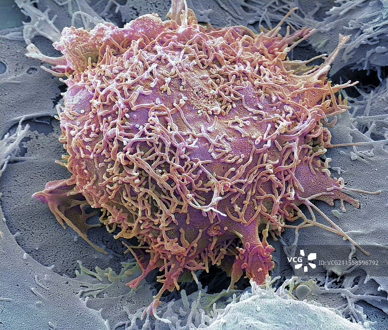 肝癌，扫描电子显微镜图像图片素材