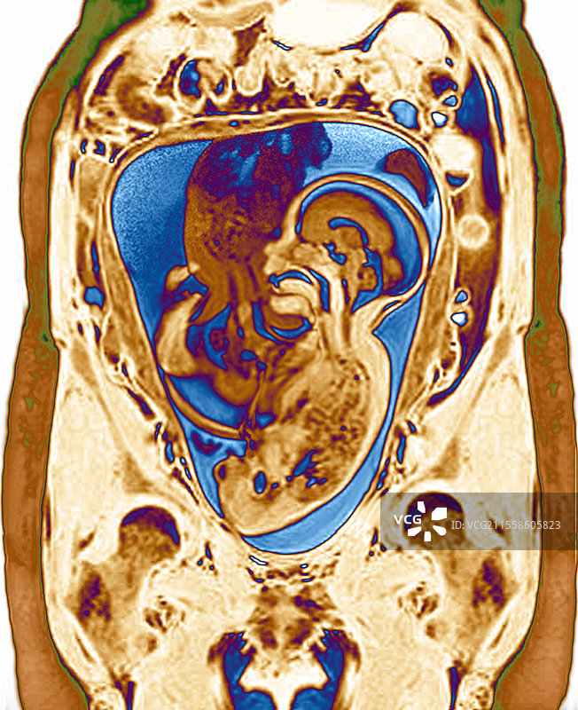双胎胎儿，MRI扫描图片素材