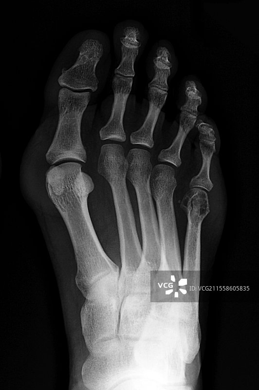拇外翻，X光片图片素材