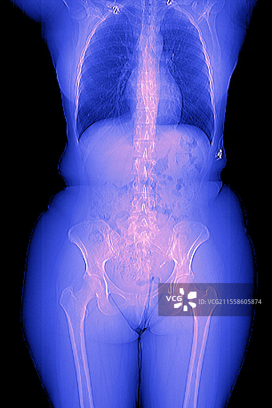 女性身体，CT扫描图片素材