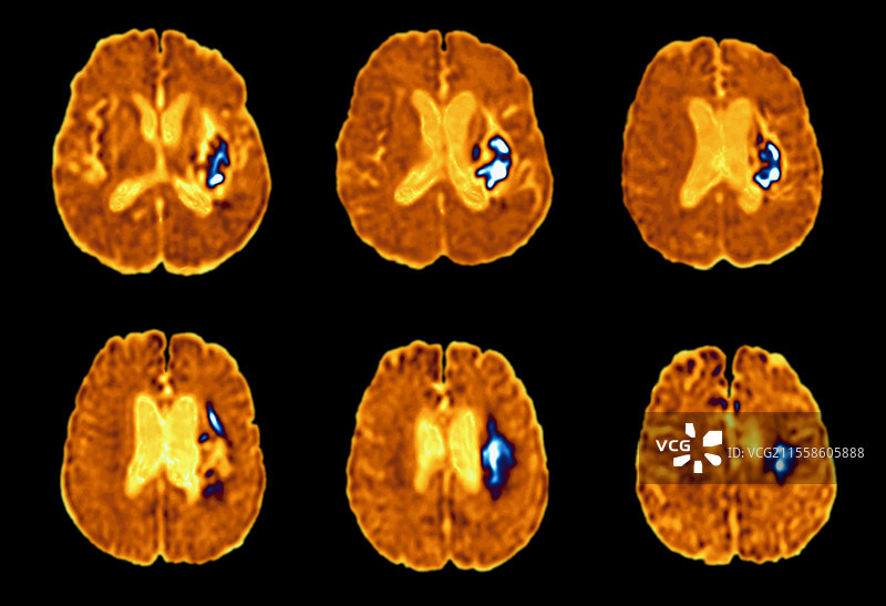 中风，脑部MRI扫描图片素材