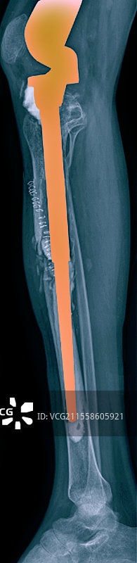 膝关节置换，X光片图片素材