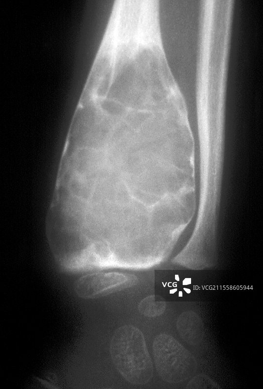 良性骨肿瘤，X光片图片素材