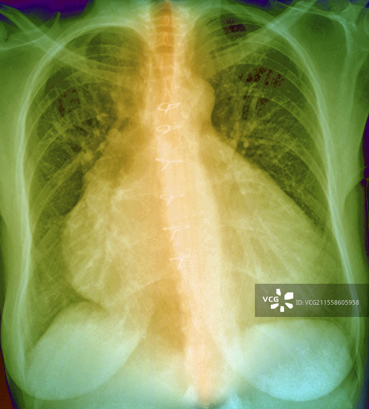 移植心脏，X光片图片素材