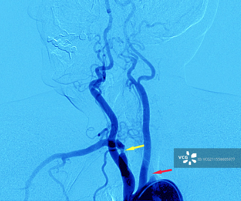 阻塞和狭窄的动脉，血管造影图片素材