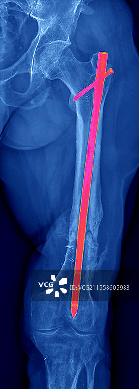 股骨骨折的钉子，X光片图片素材
