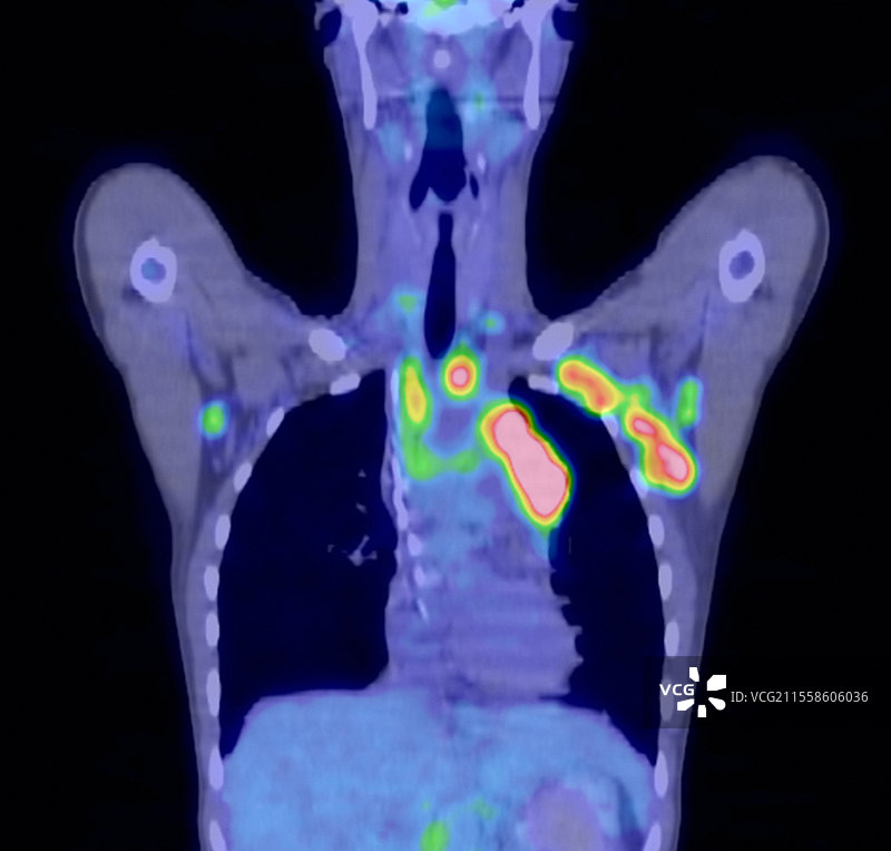霍奇金淋巴瘤，PET扫描图片素材