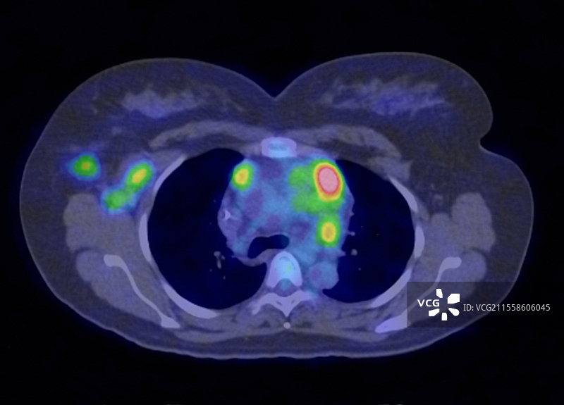 霍奇金淋巴瘤，PET扫描图片素材